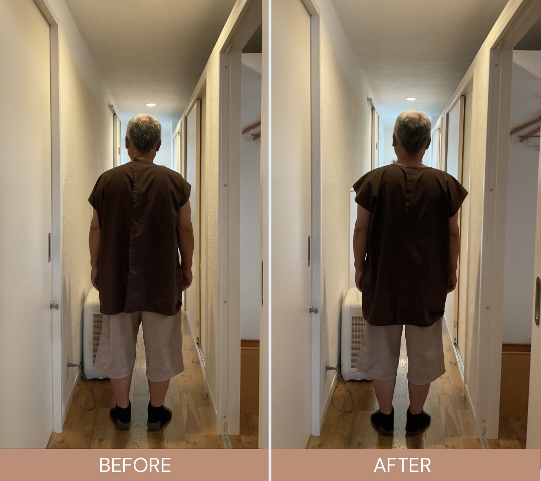 甲南山手、深江近くのOhana.はり灸院で姿勢改善施術を行った、ビフォーアフター写真